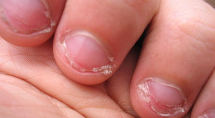Mensen die op hun nagels bijten hebben allemaal één ding gemeen, zo blijkt uit een studie