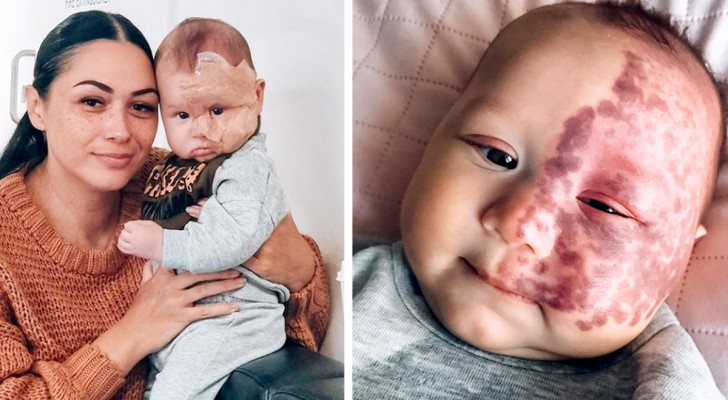 People criticize this mother for removing a birthmark from her son's face with a laser. "The motivation is not what they believe it to be"