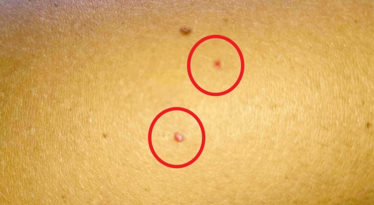 Did you suddenly notice these red dot lesions on your body, but you don't know what they are? Well, find out here