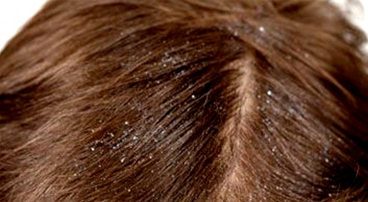Dandruff: how to eliminate it permanently in just a few simple steps