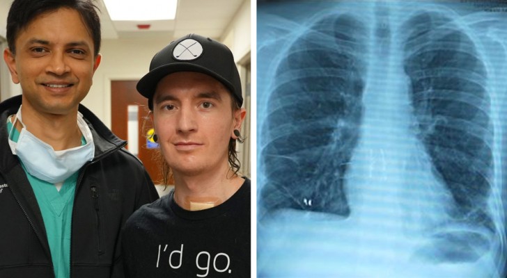 En man räddas genom att få två bröstproteser istället för lungor i väntan på transplantation
