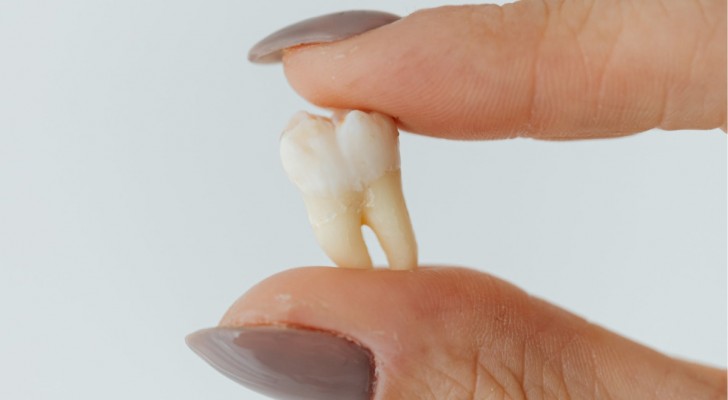 Les dents de sagesse disparaissent progressivement : quelle en est la raison ?